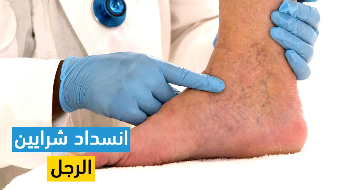 انسداد شرايين الرجل